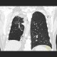 Bronchiectasias, postspecific changes: CT - Computed tomography